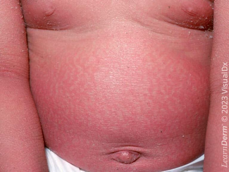 Erythroderma with exfoliation in a child with infantile psoriasis.