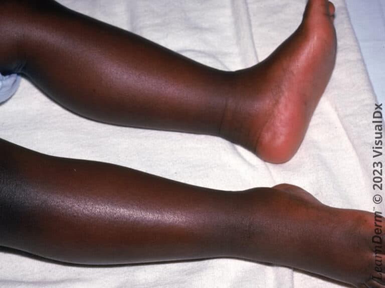 Diffuse erythema of the legs and feet in erythroderma induced by a medication.