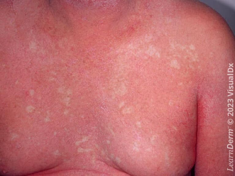 Érythrodermie avec îlots réservés de peau saine chez un(e) patient(e) atteint(e) de pityriasis rubra pilaire