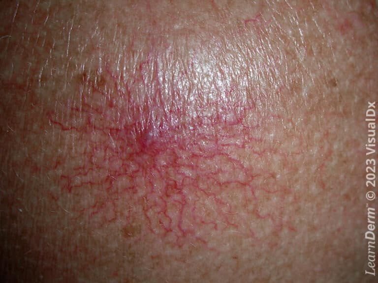 Radiating telangiectasias typical of a spider angioma.