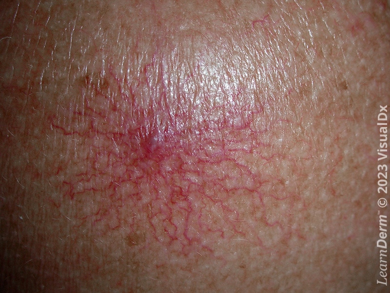 What Is Spider Telangiectasia What Is Spider Telangiectasia