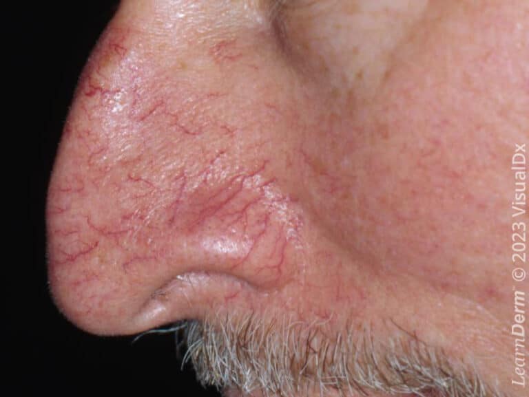 Telangiectasias associated with rosacea.