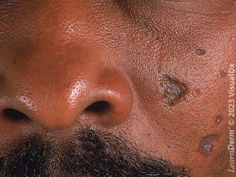 Sunken, atrophic, and hyperpigmented scars on the cheek following discoid lupus.