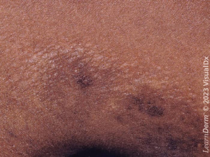 Atrophy - LearnDerm