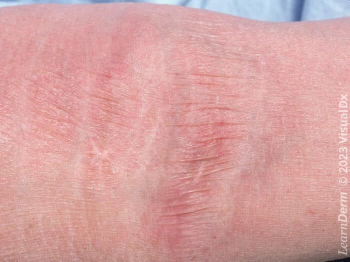 Atrophy - LearnDerm