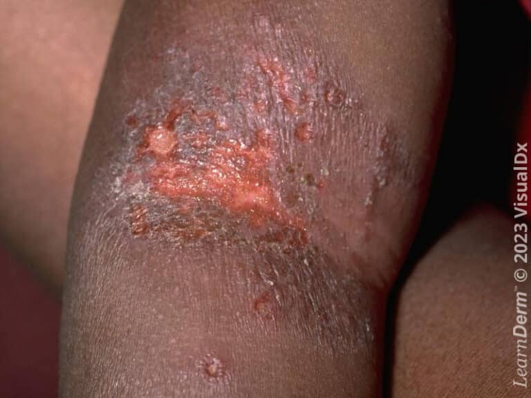 Erosions of eczema herpeticum at the antecubital fossa.
