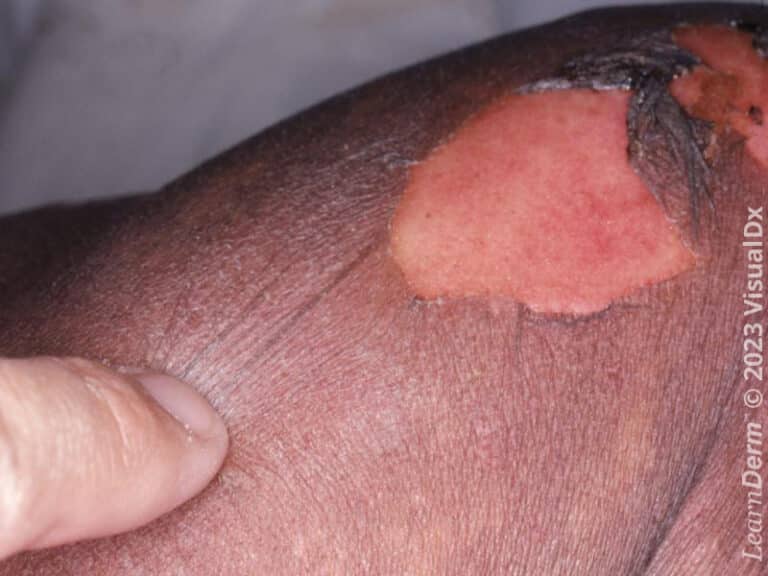 Large erosion in a patient with toxic epidermal necrolysis.