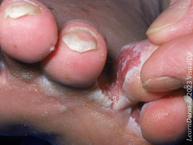 Erosion in tinea pedis.