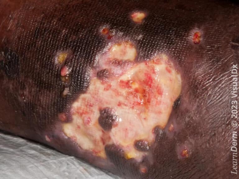 Large ulcer in pyoderma gangrenosum.