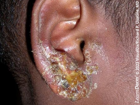 Purulence and crusting of impetigo on the earlobe.