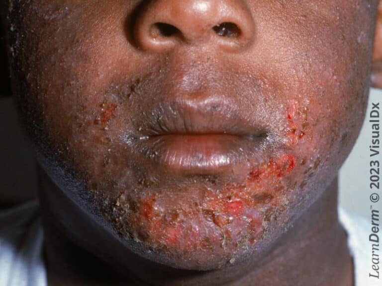 Erosões e placas grossas marrons com crostas em criança com dermatite atópica impetiginosa.