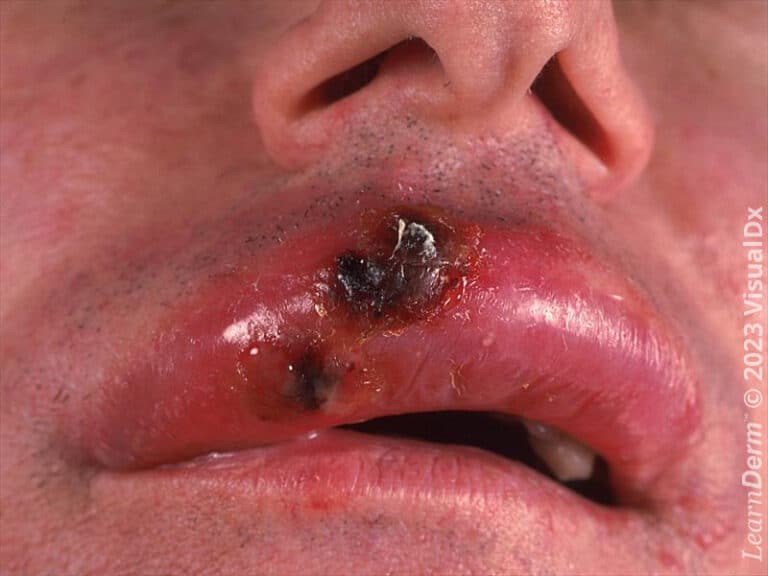 Costra hemorrágica de la mucosa labial en el virus del herpes simple.