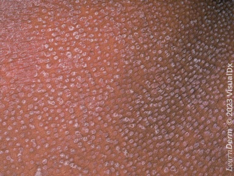 Multiple follicular-based scaly papules of pityriasis rubra pilaris.