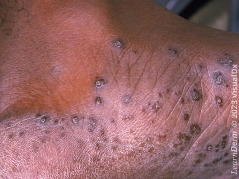 Papules plantaires épaisses et squameuses dans lʼarthrite réactionnelle