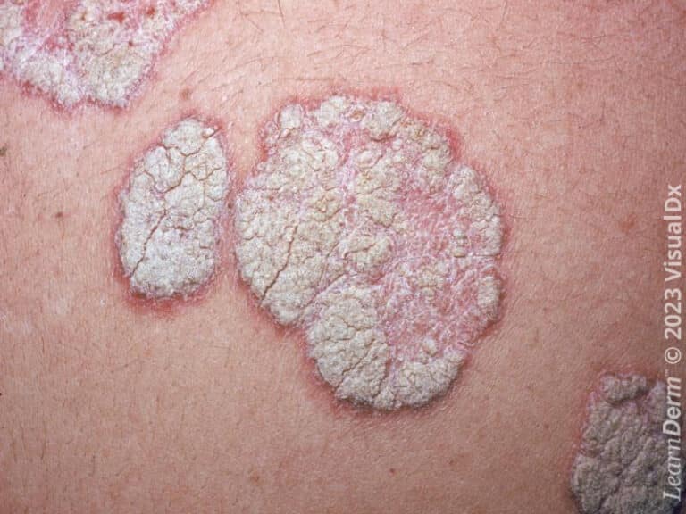 Thick, white, sharply bordered scaly plaques of psoriasis.