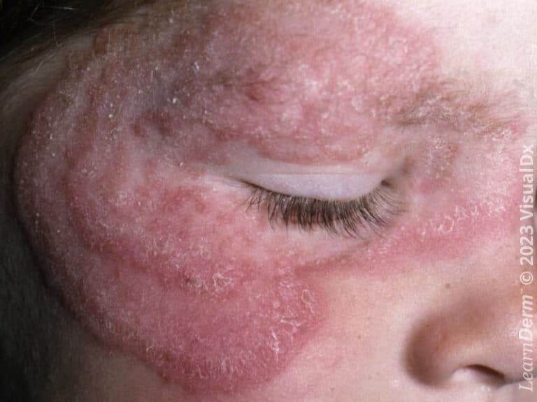 Large annular scaly erythematous plaques typical of tinea faciei.