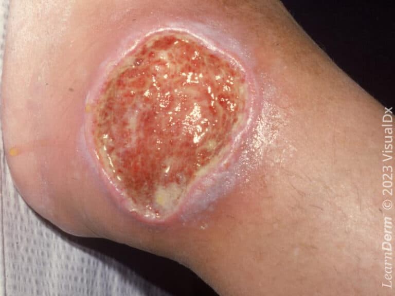 Close-up of a large, granulating ulcer with a pink and violaceous border on the lateral ankle.