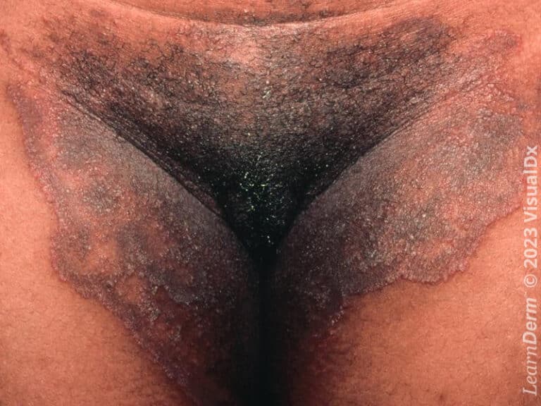 Tinea cruris [dark skin]