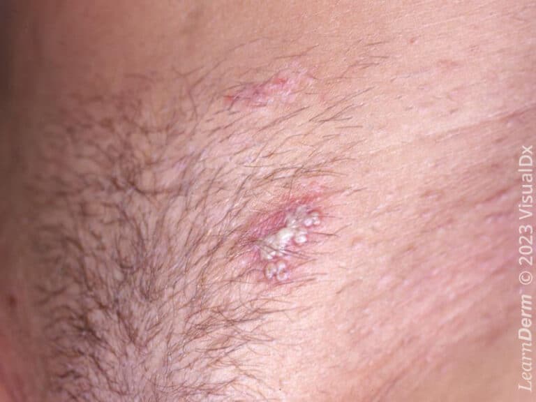 Genital herpes simplex virus