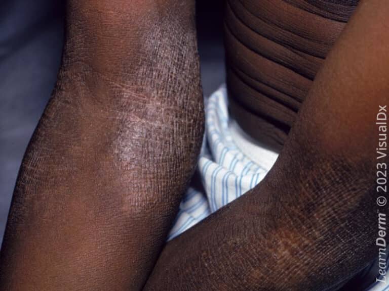 Atopic dermatitis