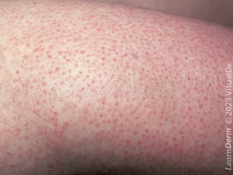 Keratosis pilaris