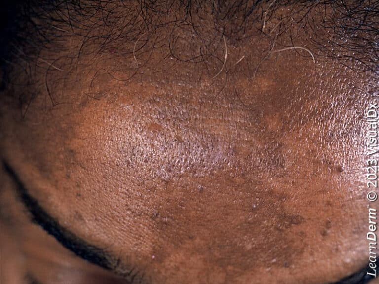 Melasma