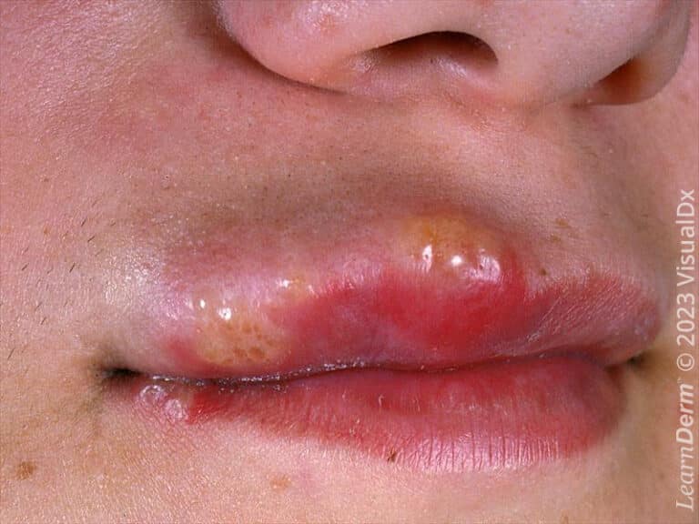 Orofacial herpes simplex virus