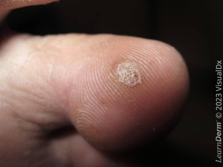 Plantar wart