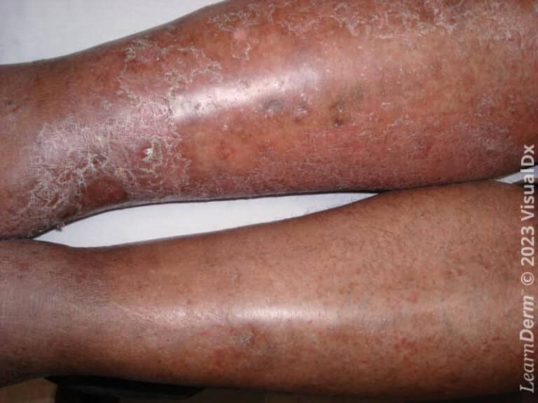 Dermatitis por estasis