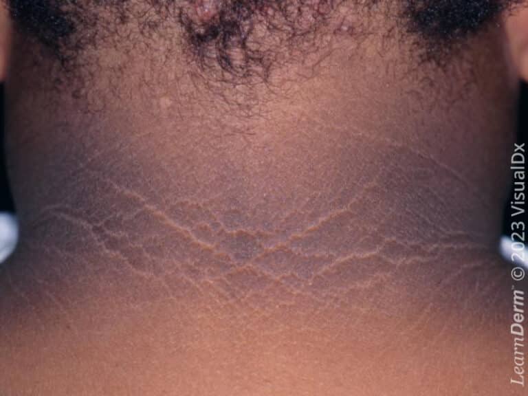 Acanthosis nigricans