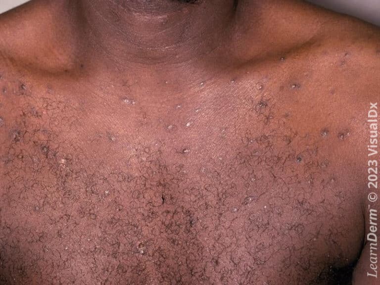 Folliculitis