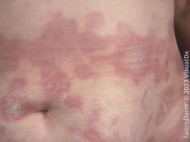 Morphea