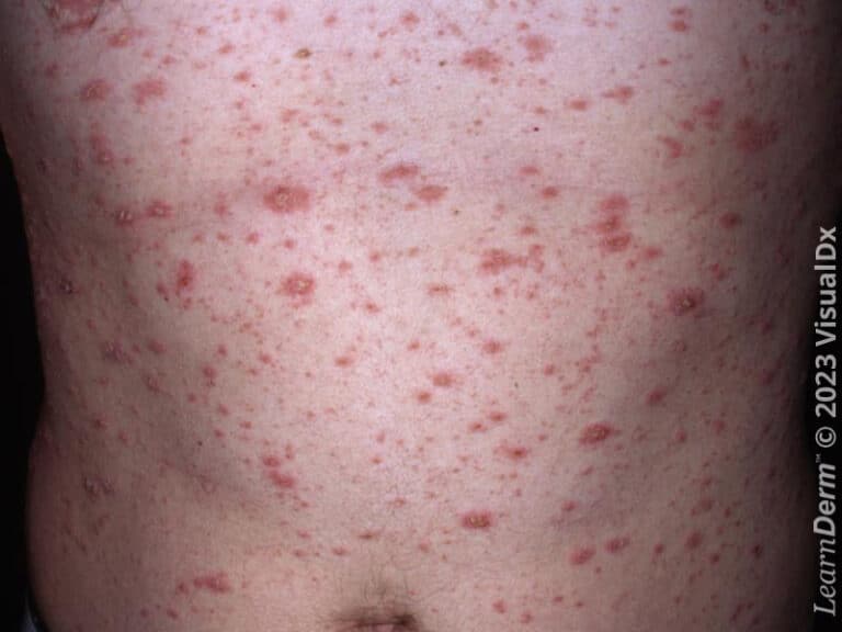 Pityriasis rosé