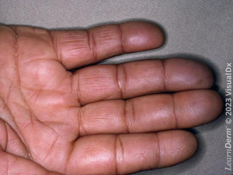 Phénomène de Raynaud