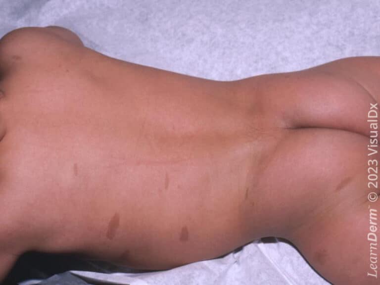 Neurofibromatose
