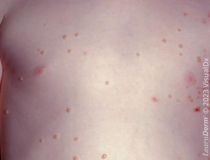 Molluscum contagiosum