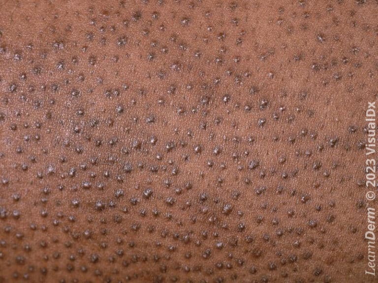 Keratosis pilaris