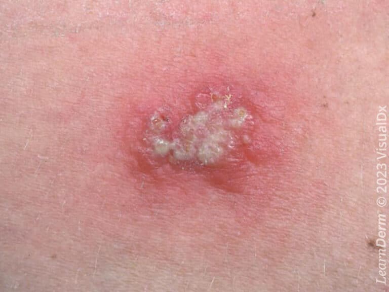 Vírus herpes simplex