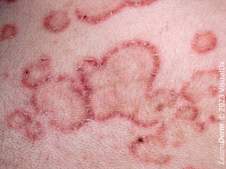 Necrolytic migratory erythema (glucagonoma syndrome)