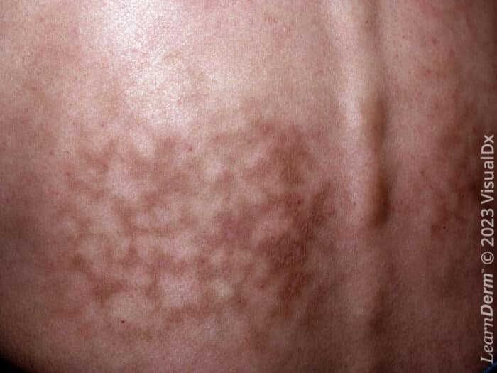 Reticular - LearnDerm