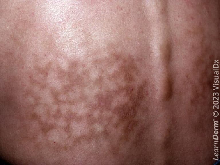 Erythema ab igne