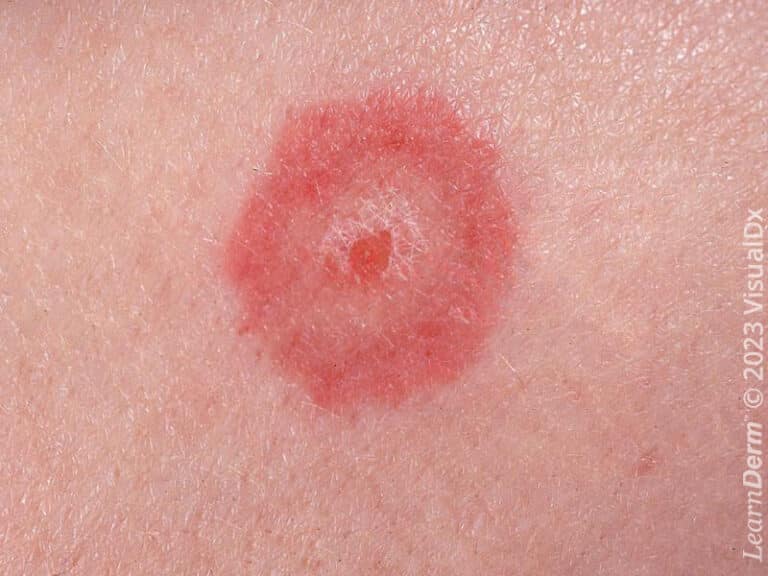 Erythema multiforme