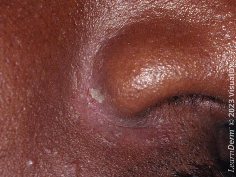 In the adult, the skin fold of the lip, cheek, and nose is a common location for erythema and scale.
