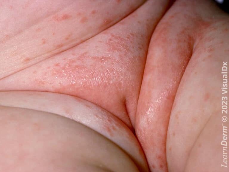 In infants, the crural folds and diaper region are common locations for erythema and fine scale.