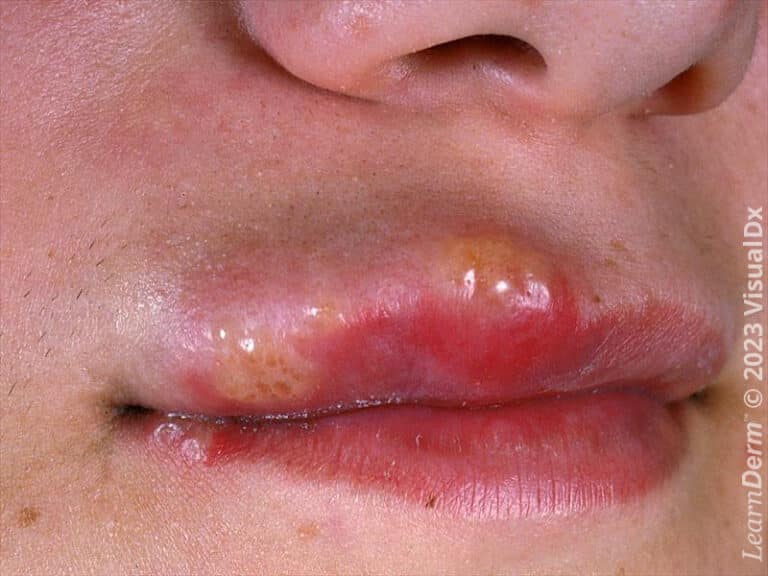 Classic labial/orofacial herpes simplex with involvement of the lips.