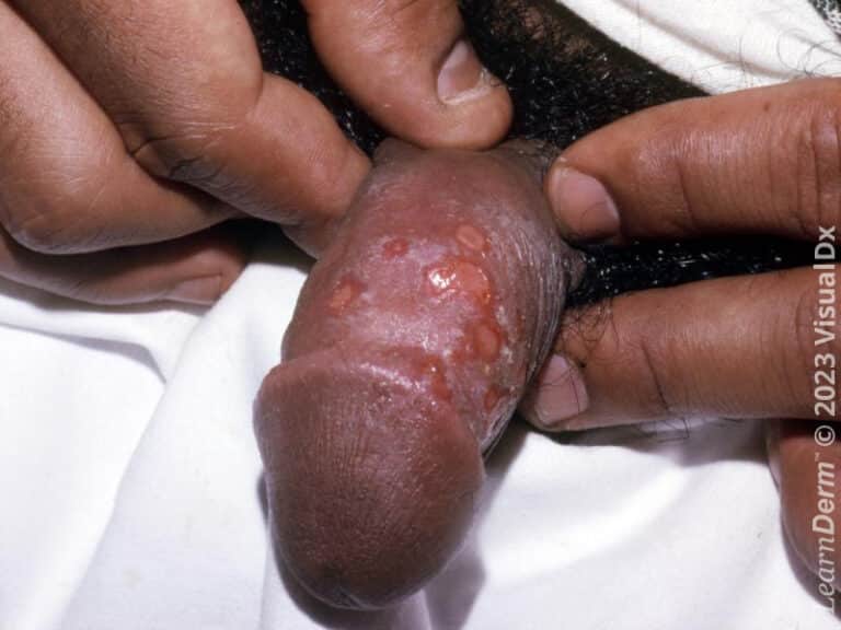 Classic genital herpes simplex with involvement of the shaft of the penis.