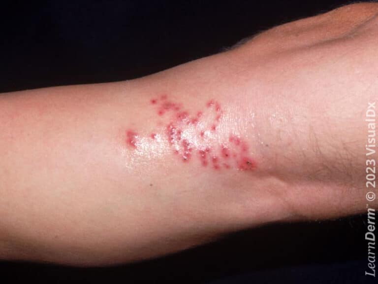Grouping of tiny erythematous papules with hemorrhagic crusts suggest herpes simplex, despite the unusual location at the leg.