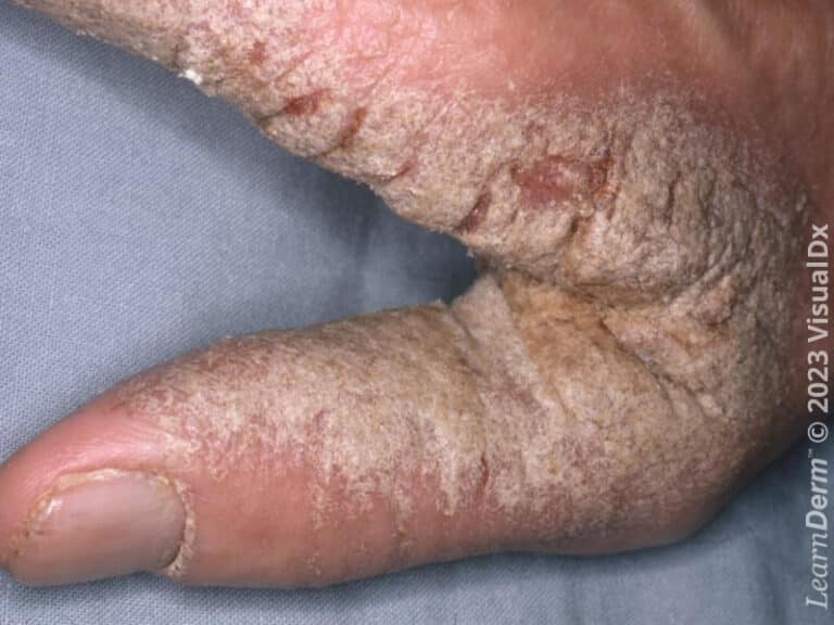 Crusted scabies with thickly heaped-up 