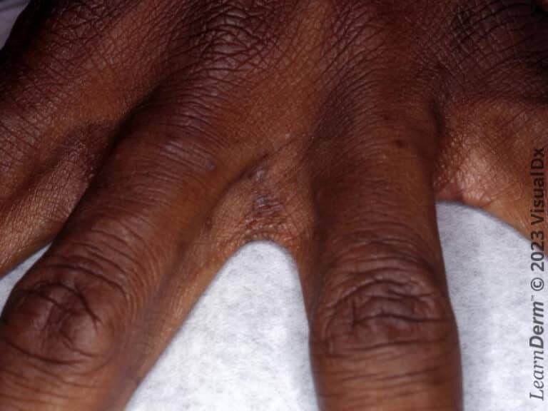 Classic scaly and smooth papules of scabies in the web spaces and on the fingers of an immunocompetent patient.