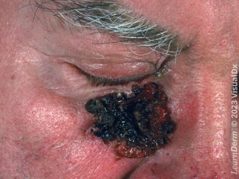 Este carcinoma basocelular de longa evolução desenvolveu uma crosta sanguinolenta sobre a úlcera cutânea causada pelo tumor.